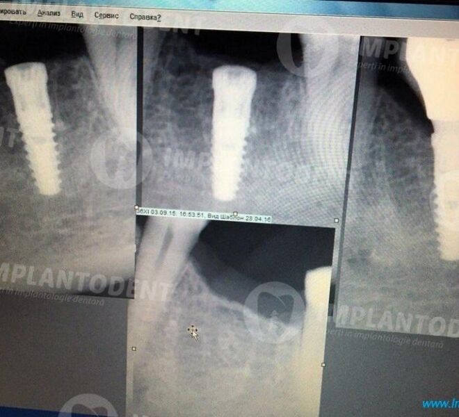 implant-dentar-german-bredent-01