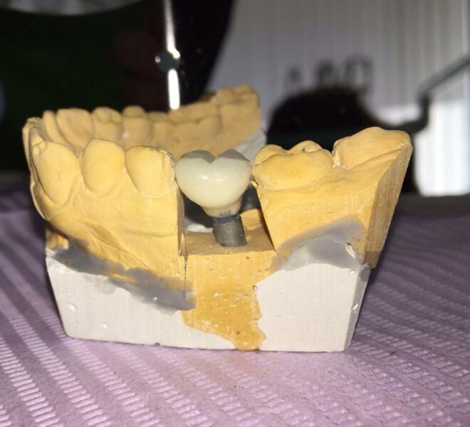 implant-dentar-german-bredent-04
