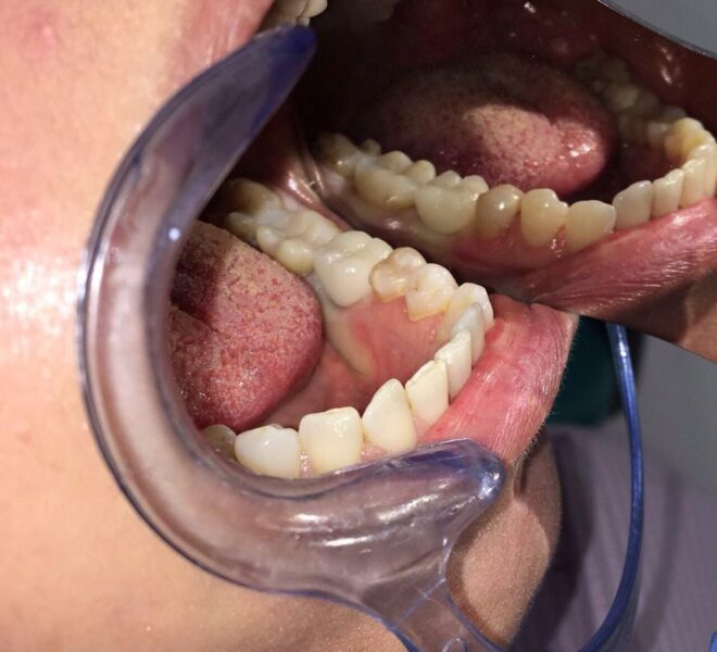 implant-dentar-german-bredent-13
