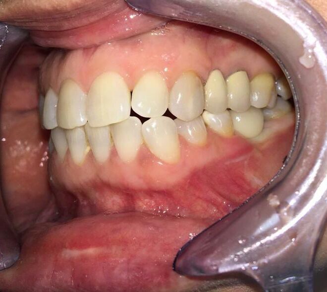 implant-dentar-german-bredent-14