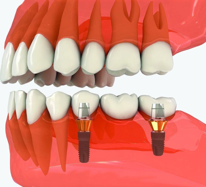 Implantarea molarilor