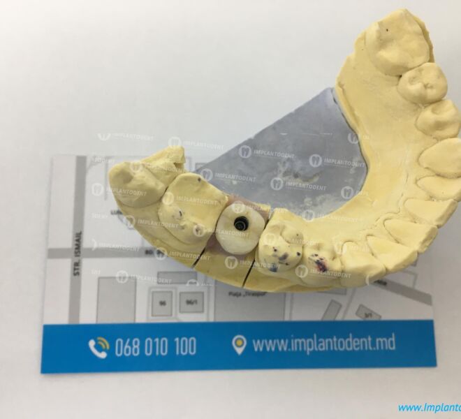 protezare-dentium-2009-01